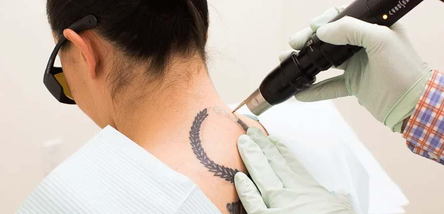 Tattoo Removal